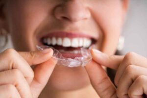 Teeth Aligners, clear braces should be custom fit by your dentist