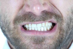 Teeth Grinding has increased according to dentists. how to prevent teeth grinding